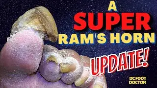 You Should See Him Now! A Super Ram's Horn Update: Trimming and Treating Severe Fungal Toenails