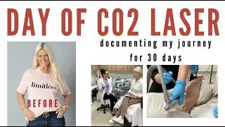 DAY of CO2 LASER RESURFACING- WHY?  SERIES to show the DAILY 
