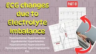Electrolyte Imbalance & its impact on ECG Changes | Hypo/hyperkalemia & Hypo/hypercalcemia |  Part 1