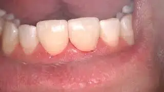 8,9 Lisi Press Crowns Cementation