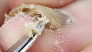Fungus toenail cleaning.