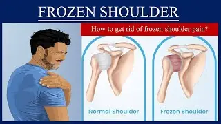 Frozen Shoulder (Adhesive Capsulitis)\Shoulder Pain  - How to cure frozen shoulder quickly?