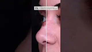 Large Mole Removal on Nose by Dr. Hooman Khorasani | NYC Cosmetic Surgeon and Dermatologist