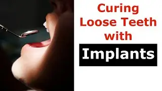 Curing Loose Teeth with Implants