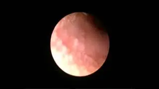 allergie du conduit