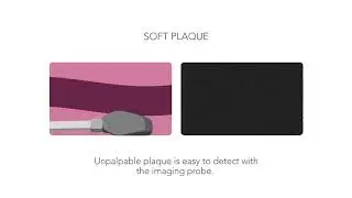 Imaging is crucial for plaque detection