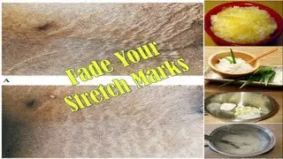 FADE Your Stretch Marks (Remedies to Clear Up Pesky Stretch Marks)
