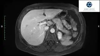 Hepatectomia extrema no câncer colorretal metastático
