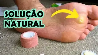 Olho de Peixe no Pé - Como Tirar e Resolver Isso