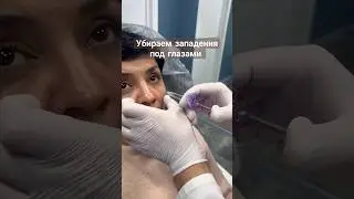 Убираем западения под глазами.