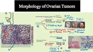Morphology of Ovarian Tumors -Special Pathology @Dr.M-Usman