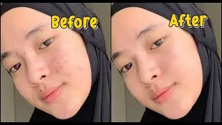 Cara Edit Foto Menghilangkan Jerawat Di HP Android