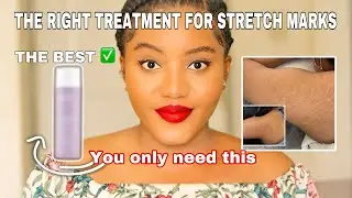 A CURE FOR STRECH MARKS? HOW TO GET RID OF STRECH MARKS | GOODBYE FOREVER