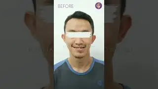 BEFORE AFTER PERAWATAN BEHEL UNTUK ORANG DEWASA 