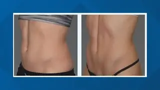 Tone and sculpt your body with magnetic muscle stimulation - New Day NW