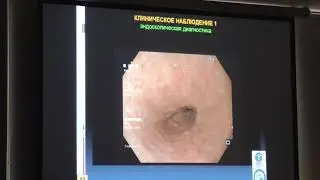 63 Pirogov SS Lymphocytic esophagitis: a rare observation