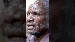 Mpox new disease alert