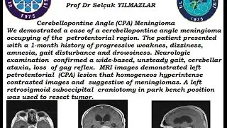 Left Cerebellopontine meningioma 1478411