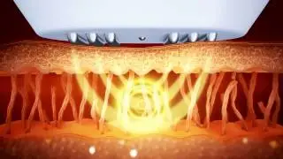 EndyMed's Unique 3DEEP RF Technology