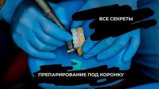 ПРЕПАРИРОВАНИЕ ПОД КОРОНКУ(все секреты препа)