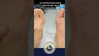 Step into Elegance - Perfect Bunion Correction by Dr. Kevin Lam |  No Scar Bunion Surgery