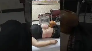 Woman's belly fat removed like this