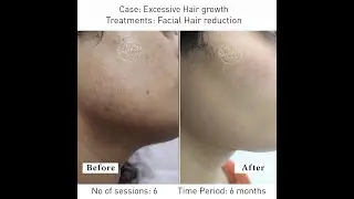 Laser Hair Reduction Before and After | Excessive Hair Growth