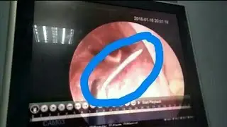 Tinik sa Lalamunan ni Mommy