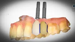 Dental Implants - AMAZING NEW 3D Technology!