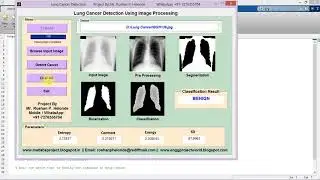 Lung Cancer Detection Using Image Processing Full Matlab Project Code IEEE Based Project