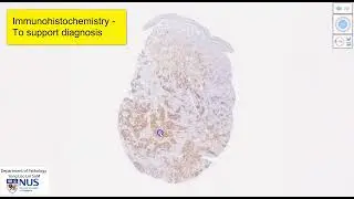 Skin - Metastatic renal cell carcinoma