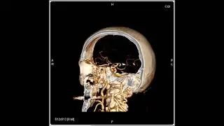 Circle of Willis CTA