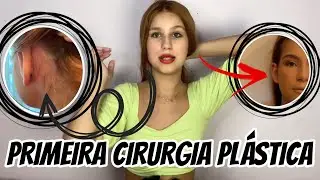 MINHA OTOPLASTIA