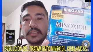 evolución del tratamiento minoxidil kirkland 5% ALEXANDER🧔🏻