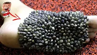 How to Remove Giant Lice on my Feet #206