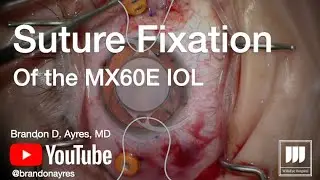 Suture Fixation of the MX60E IOL using GORE-TEX suture