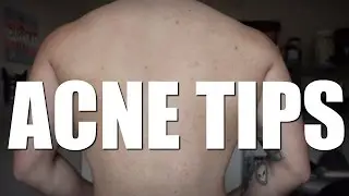 Acne Tips - FtM
