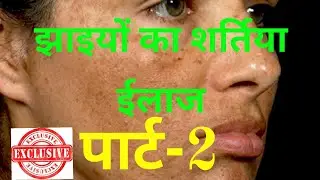 झाईयों का उपचार || झाईयों की बेस्ट क्रीम || Elocon Cream || Pigmentation || Melasma || Jhaiya
