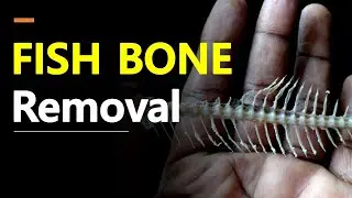 How to Remove Fishbone in Your Throat