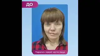 Врождённый паралич лица. Результат операции