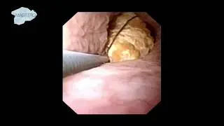 Stone Relocation from Lower to Upper Pole