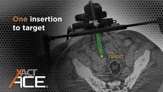 Key Features of the XACT ACE Robotic System