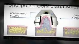 Alugar Equipamentos a Laser - Clinic Laser Locações