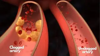 Foods to Unclog Your Arteries and Foods to Avoid to Prevent Heart Attack and Stroke