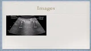 Brown EUS Case of the Month February 2018