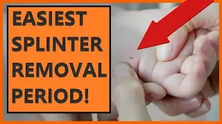 Easiest way to remove a splinter 