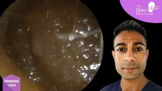 1,310 - Extremely Blocked Ear Wax Removal