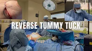 A Not So Common Procedure: Reverse Tummy Tuck | Charles Galanis MD| Galanis Plastic Surgery