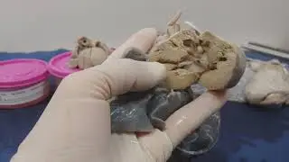 complex cardiac anatomy part 2 The Fontan operation