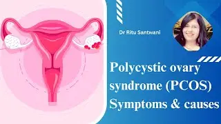 Polycystic ovary syndrome (PCOS) Symptoms and causes | Patient education I MIC
